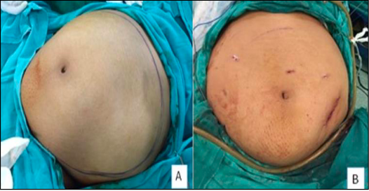 pre-op and post-op picture of abdomen